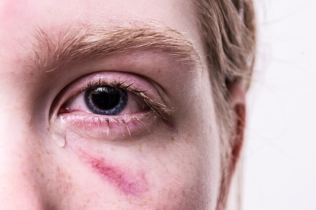 Eye Injury Attorney Hollywood, FL
